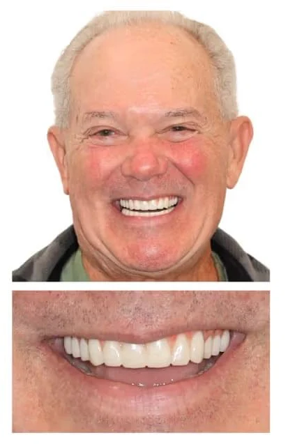After single dental implant