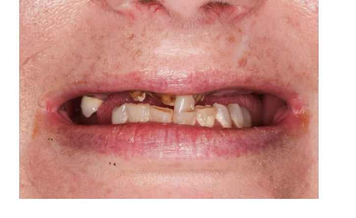 Before single dental implant