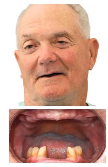 Before single dental implant